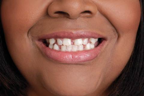 African American With Crooked Teeth