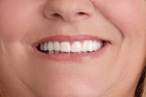 Woman With Straight Teeth